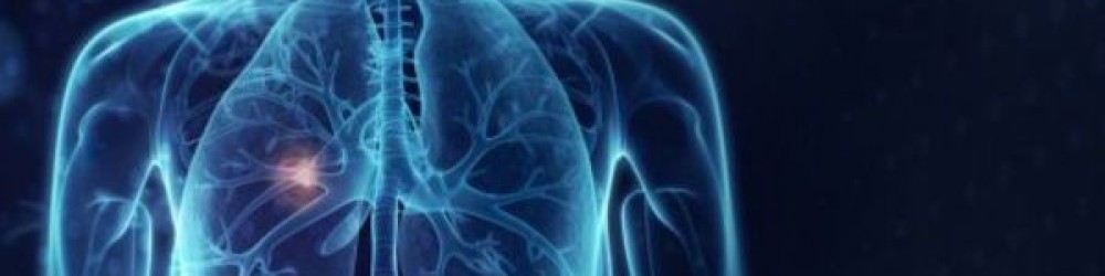 IASLC Staging Project: Lung Cancer, Thymic Tumors, and Mesothelioma IASLC Staging Project: Lung Cancer, Thymic Tumors, and Mesothelioma